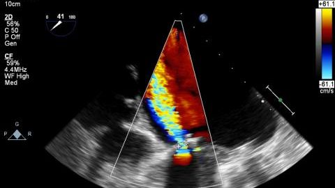 A picture of a sample echocardiogram