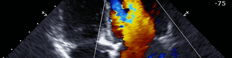 A sample picture of an Echocardiogram