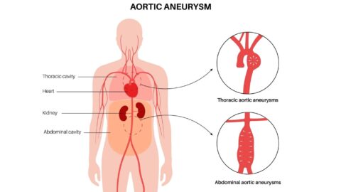 Aortic Aneurysms Thoracic Abdominal