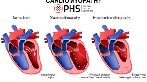 Cardiomyopathy