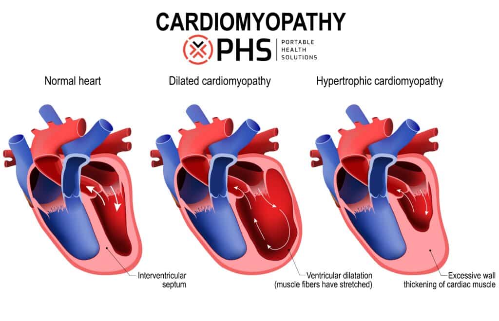 Comparison of a healthy heart and hearts with dilated cardiomyopathy and hypertrophic cardiomyopathy. 