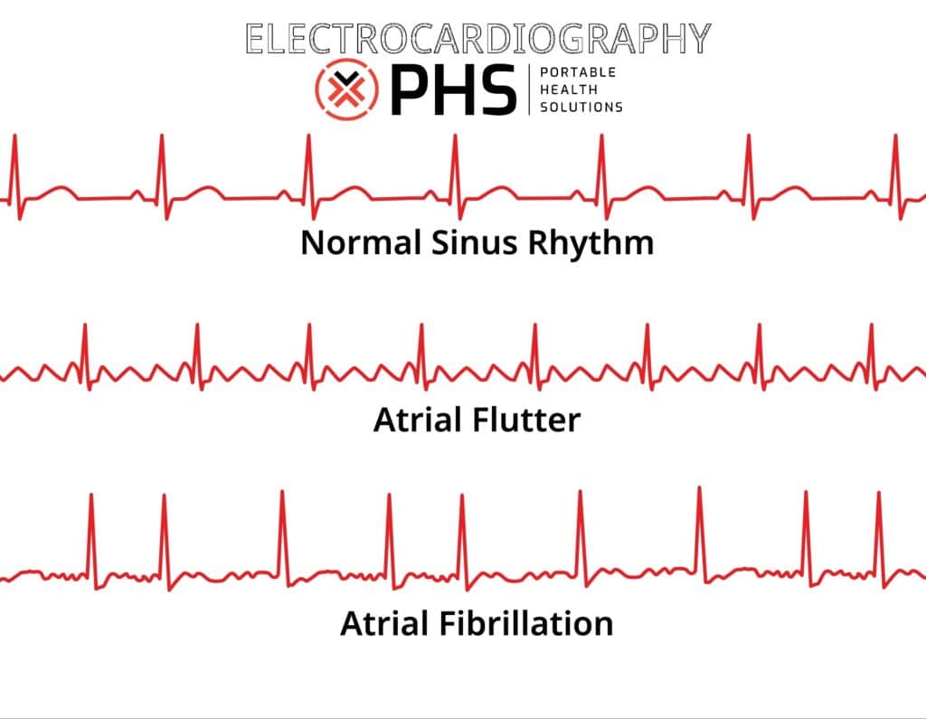 Atrial Fibrillation as compared with Atrial Flutter and Normal Sinus Rhythm, based on electrical signal readings of the heart.