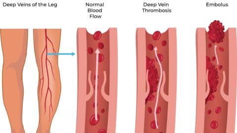 deepveinthrombosis